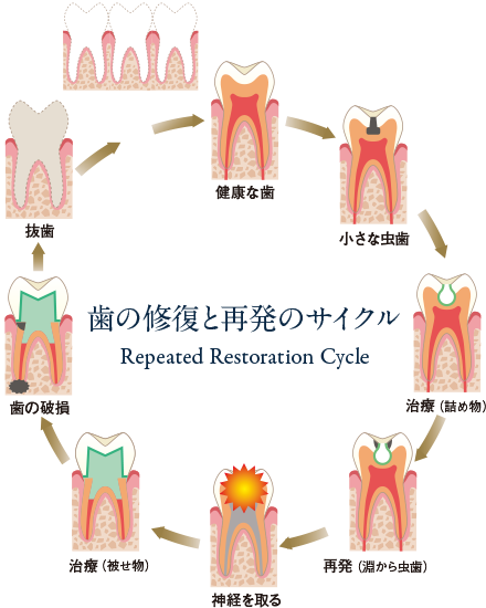歯の修復とサイクル